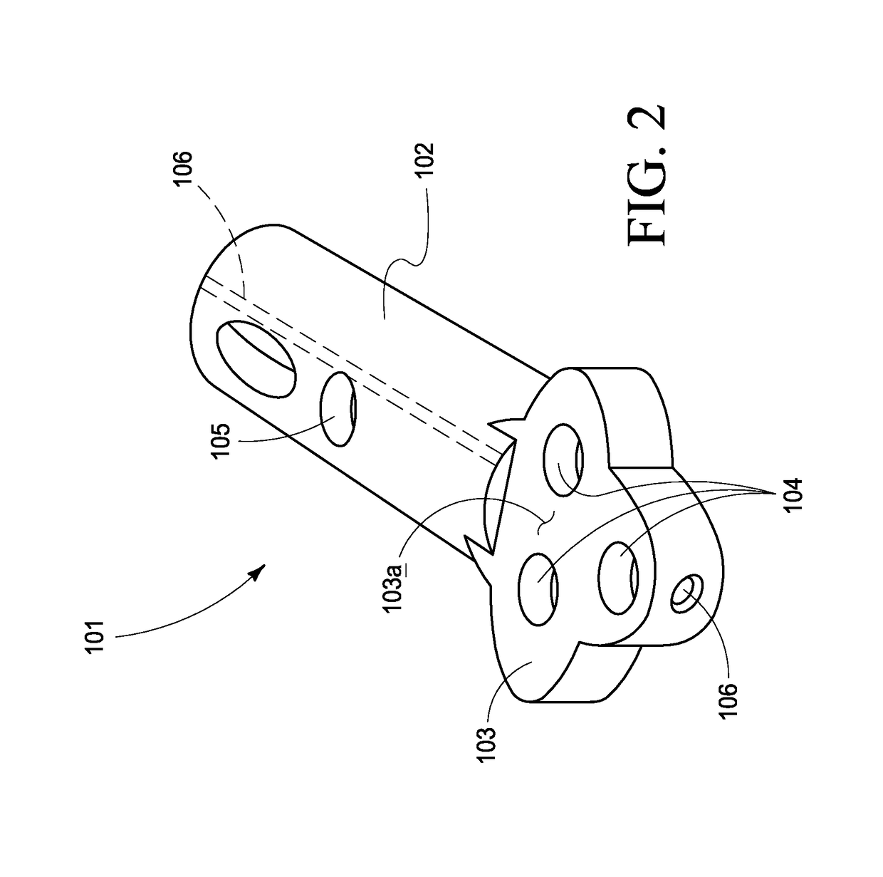 Combined intramedullary-extramedullary bone stabilization and alignment system