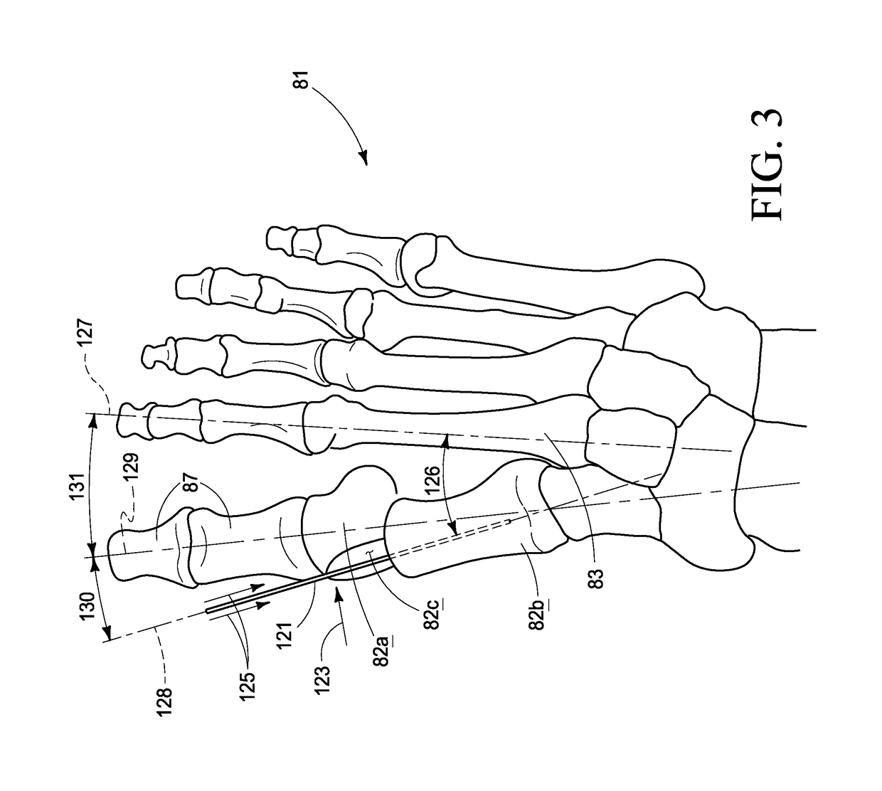 Combined intramedullary-extramedullary bone stabilization and alignment system