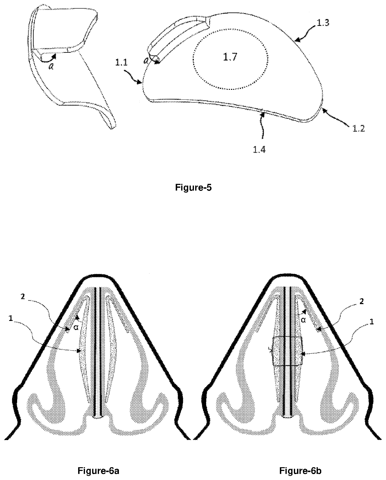 Intranasal splint comprising angled wing structure