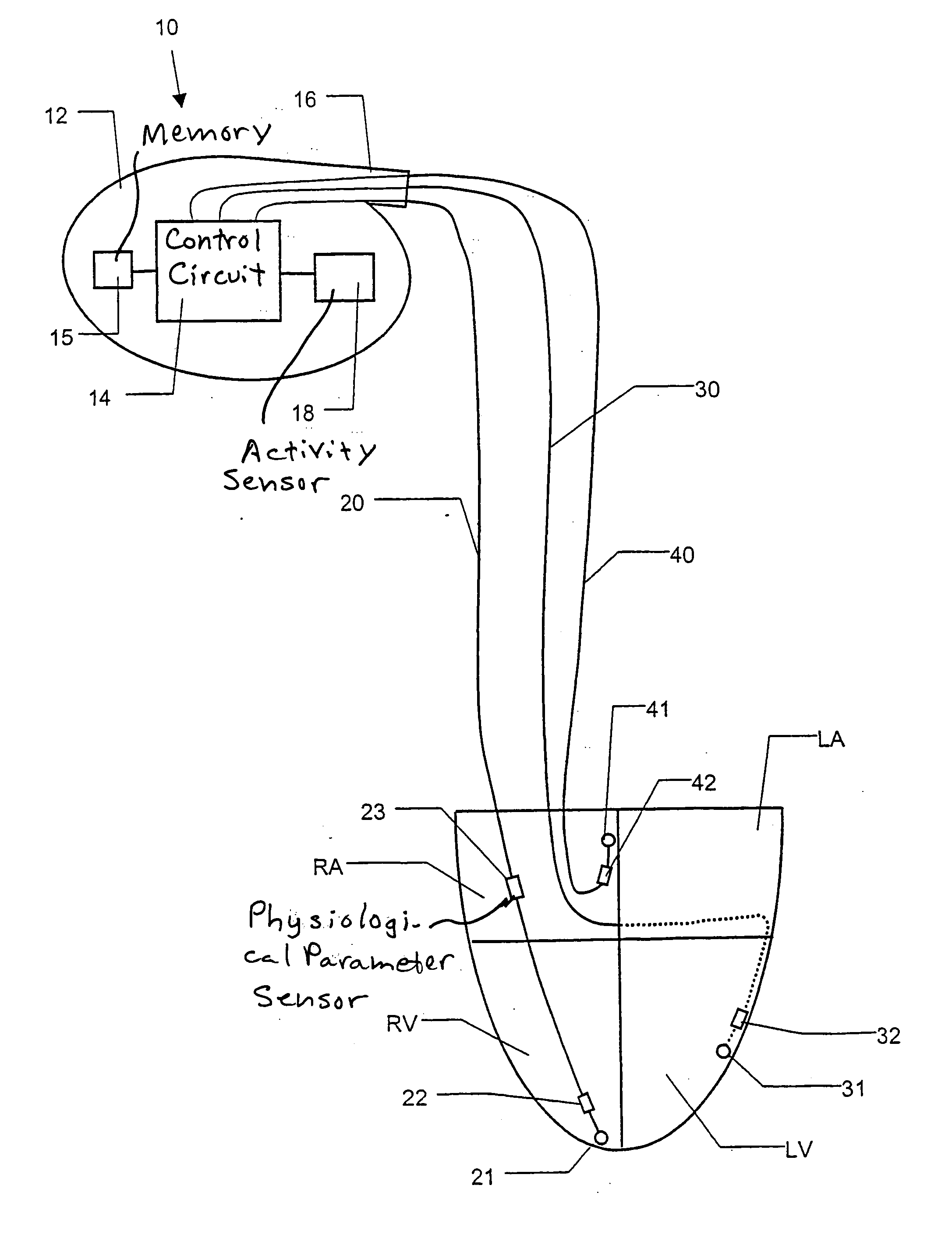 Heart monitoring and stimulating device, a system including such a device and use of the system
