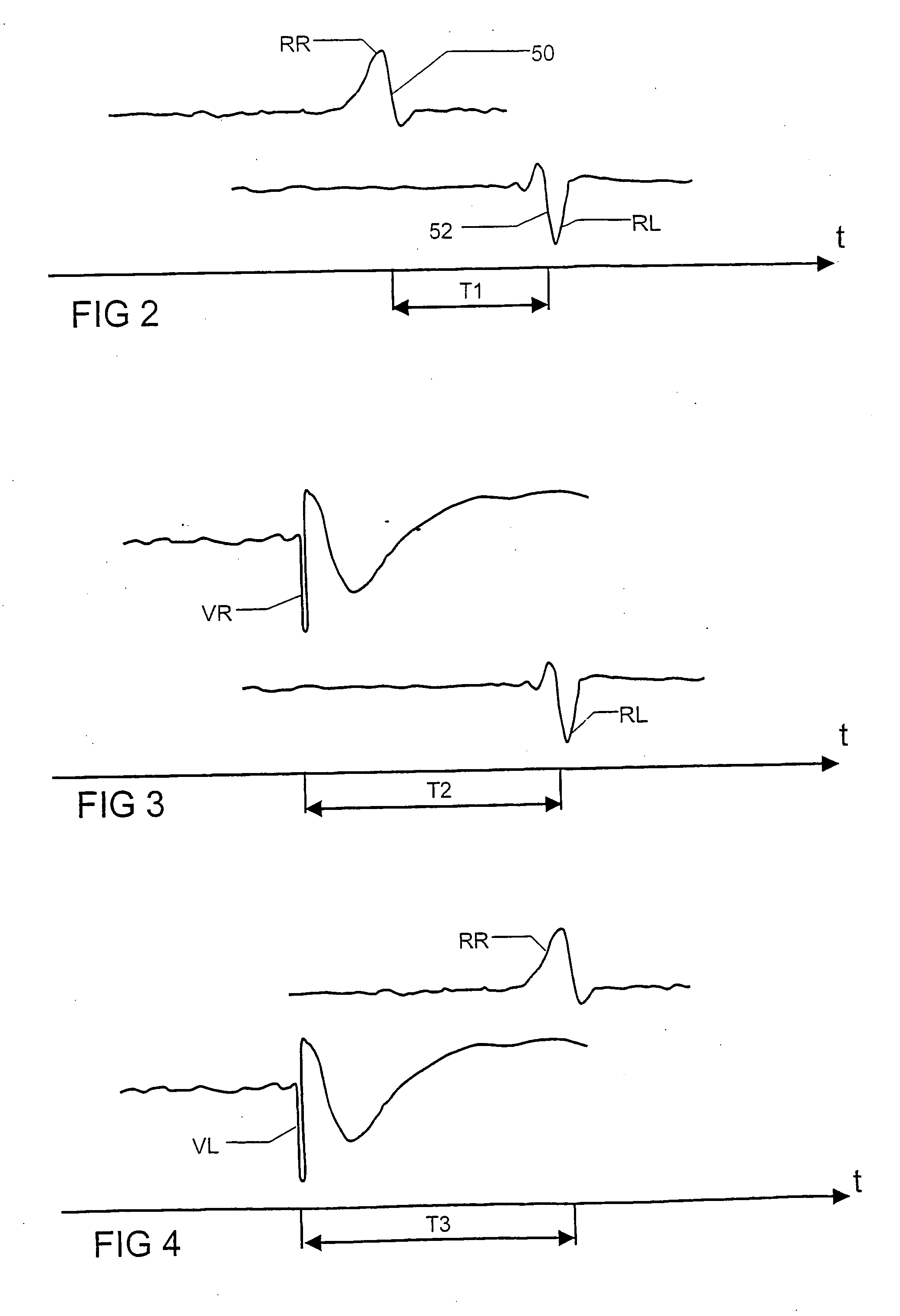 Heart monitoring and stimulating device, a system including such a device and use of the system