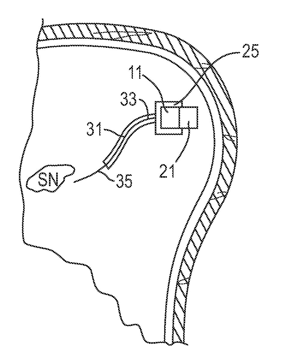 Endoscopic delivery of red/nir light to the substantia nigra to treat parkinson's disease