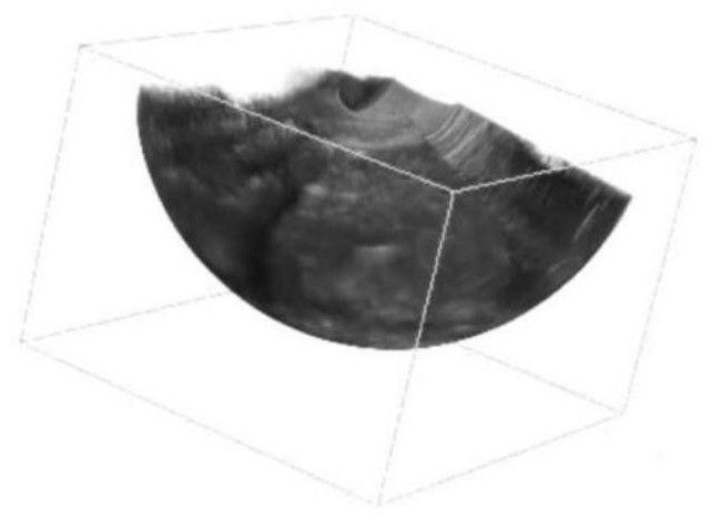 Standard section detection method of uterus three-dimensional ultrasonic image