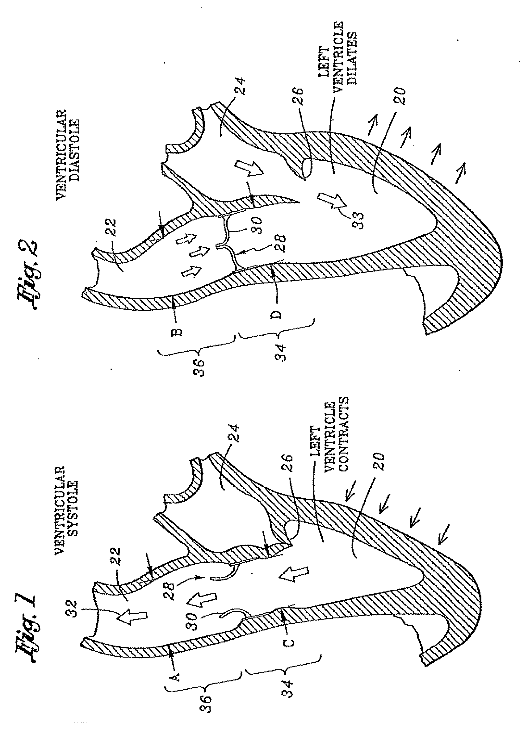 Flexible heart valve and associated connecting band