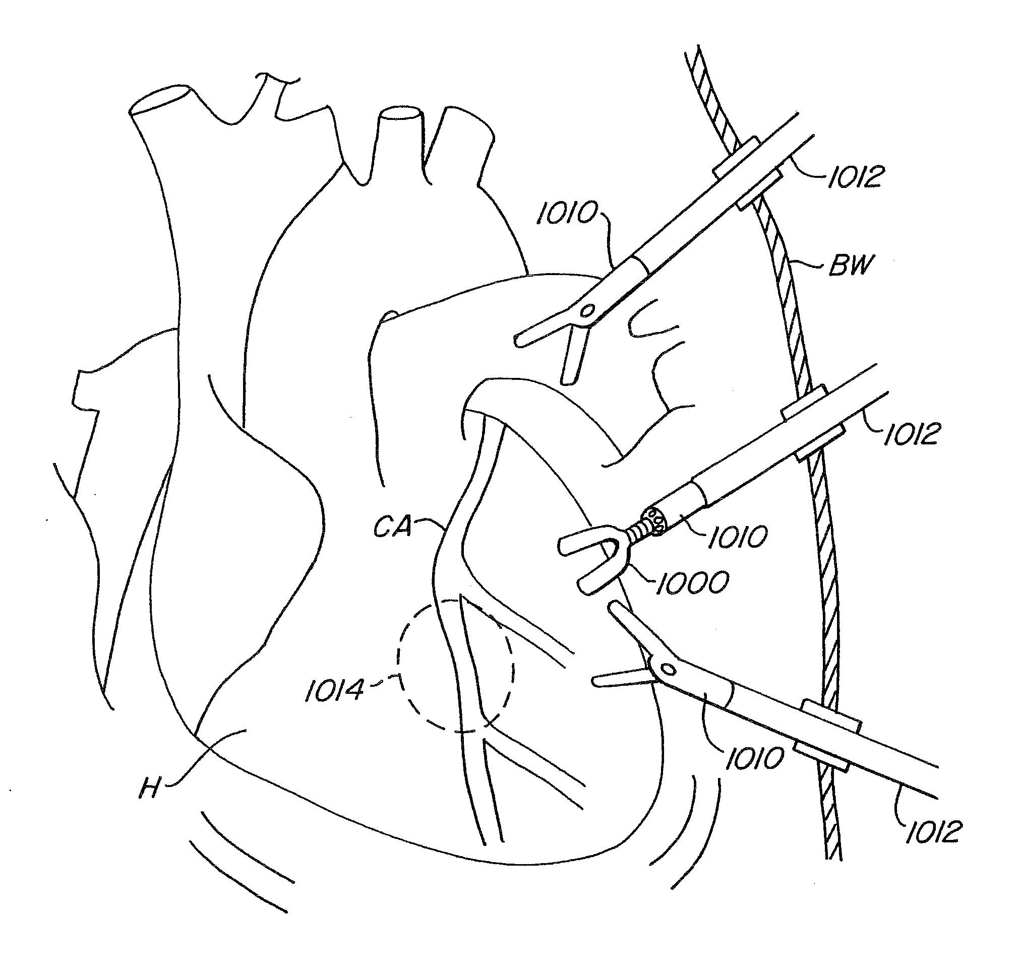Endoscopic beating-heart stabilizer and vessel occlusion fastener
