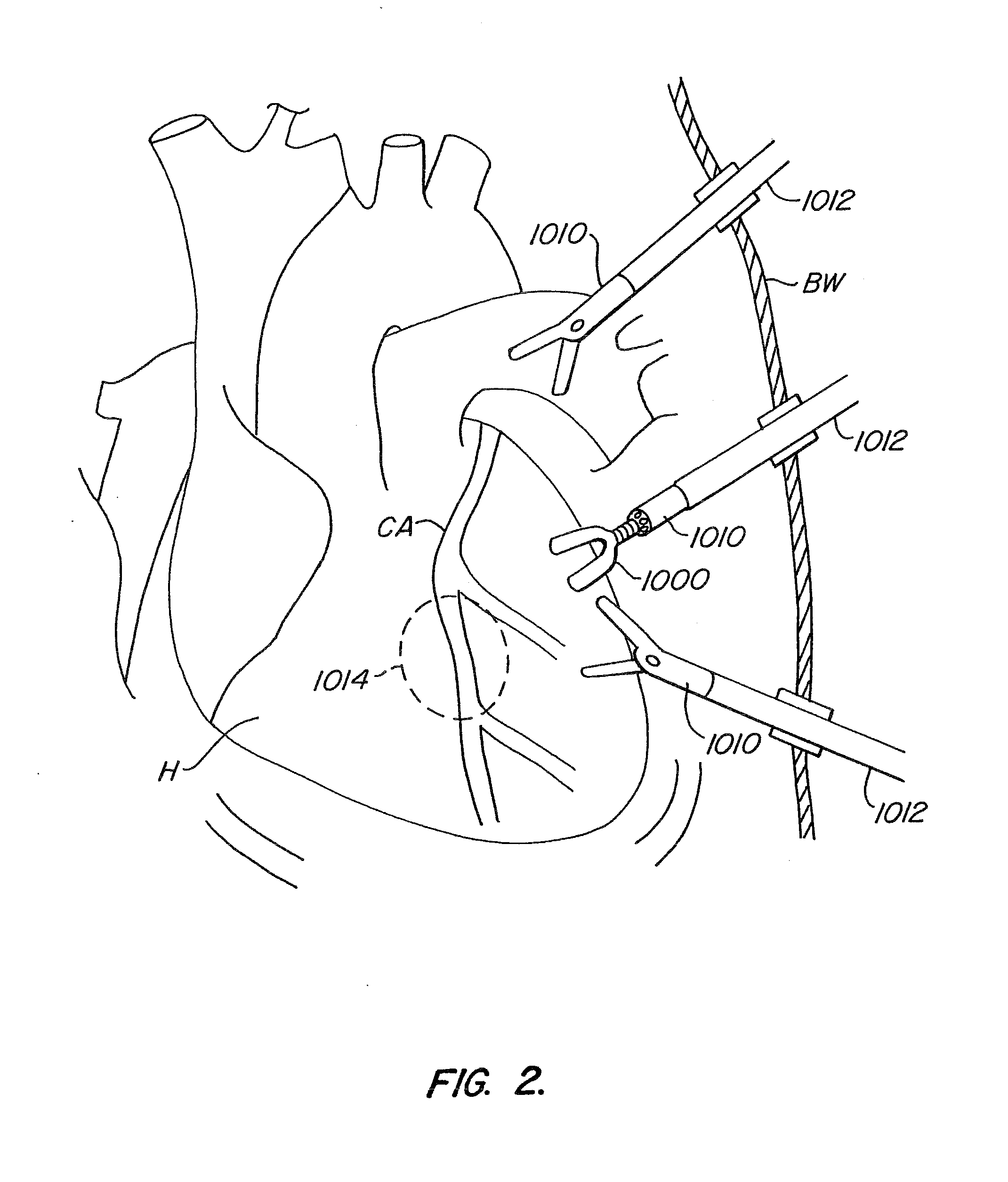 Endoscopic beating-heart stabilizer and vessel occlusion fastener