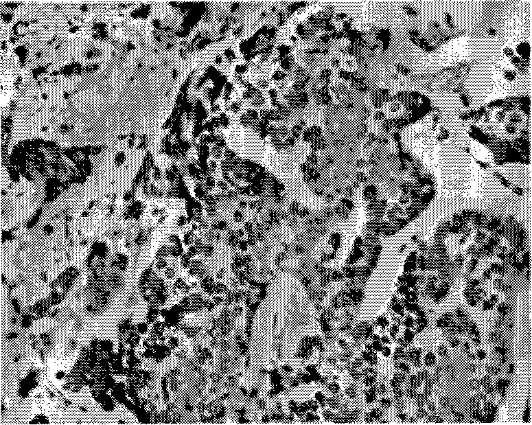 Breast cancer biological molecule marker LASS2 protein, modifying product and medical composition thereof