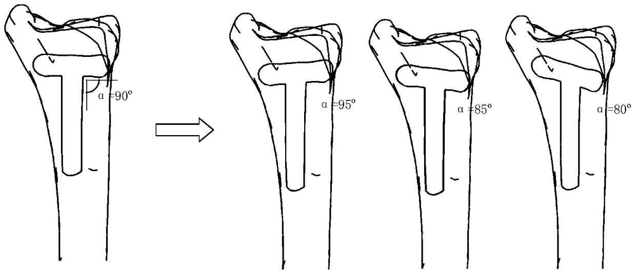Diversified design method of tibial T-shaped bone plate based on parametric technology