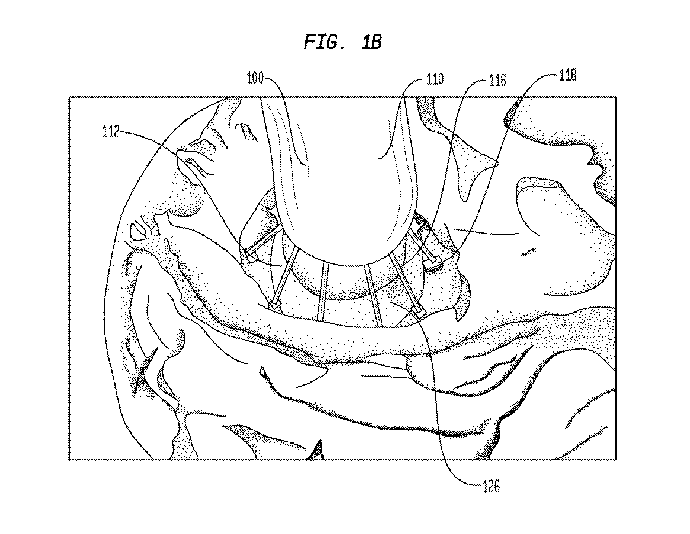 Inflatable minimally invasive system for delivering and securing an annular implant