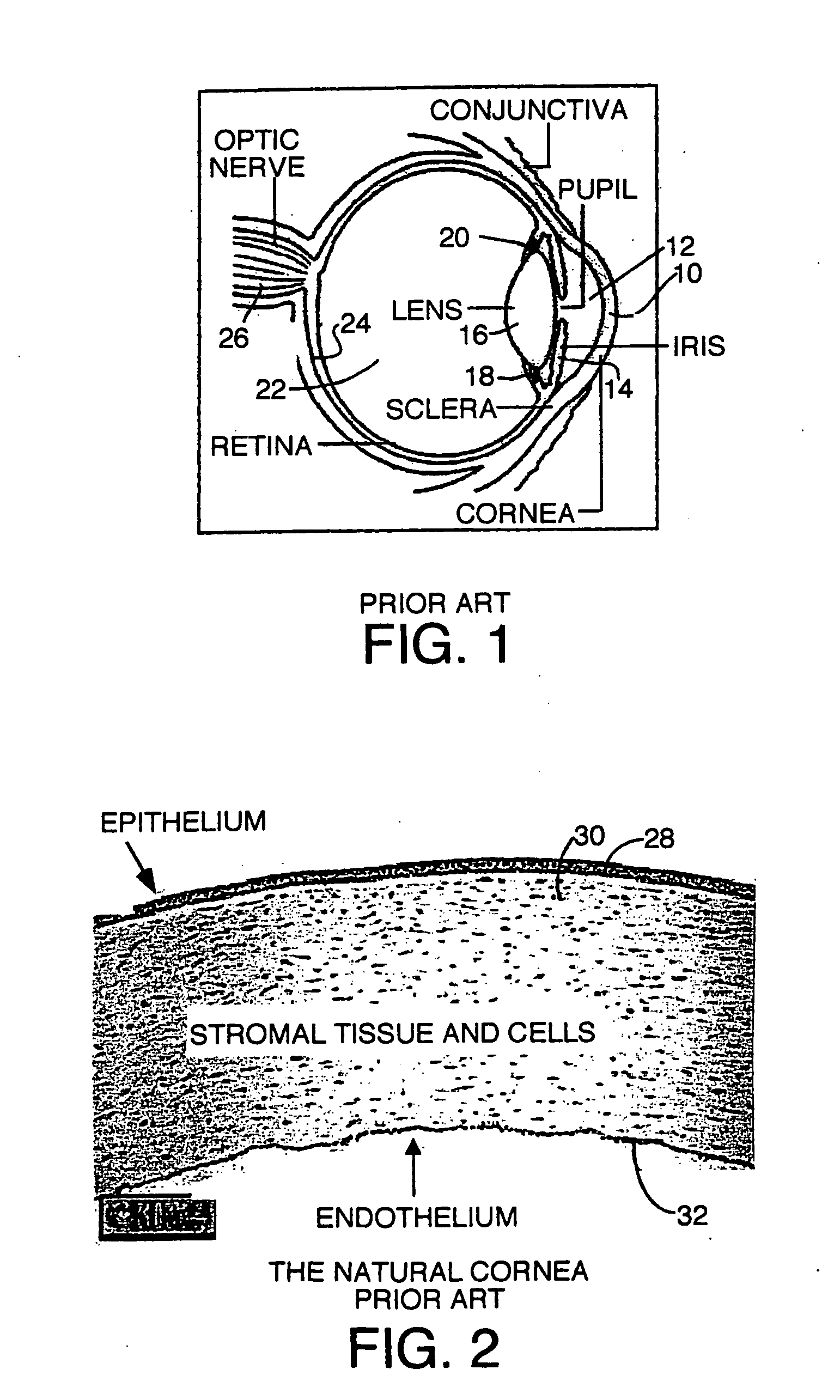 Surgical procedure and instrumentation for intrastromal implants of lens or strengthening materials