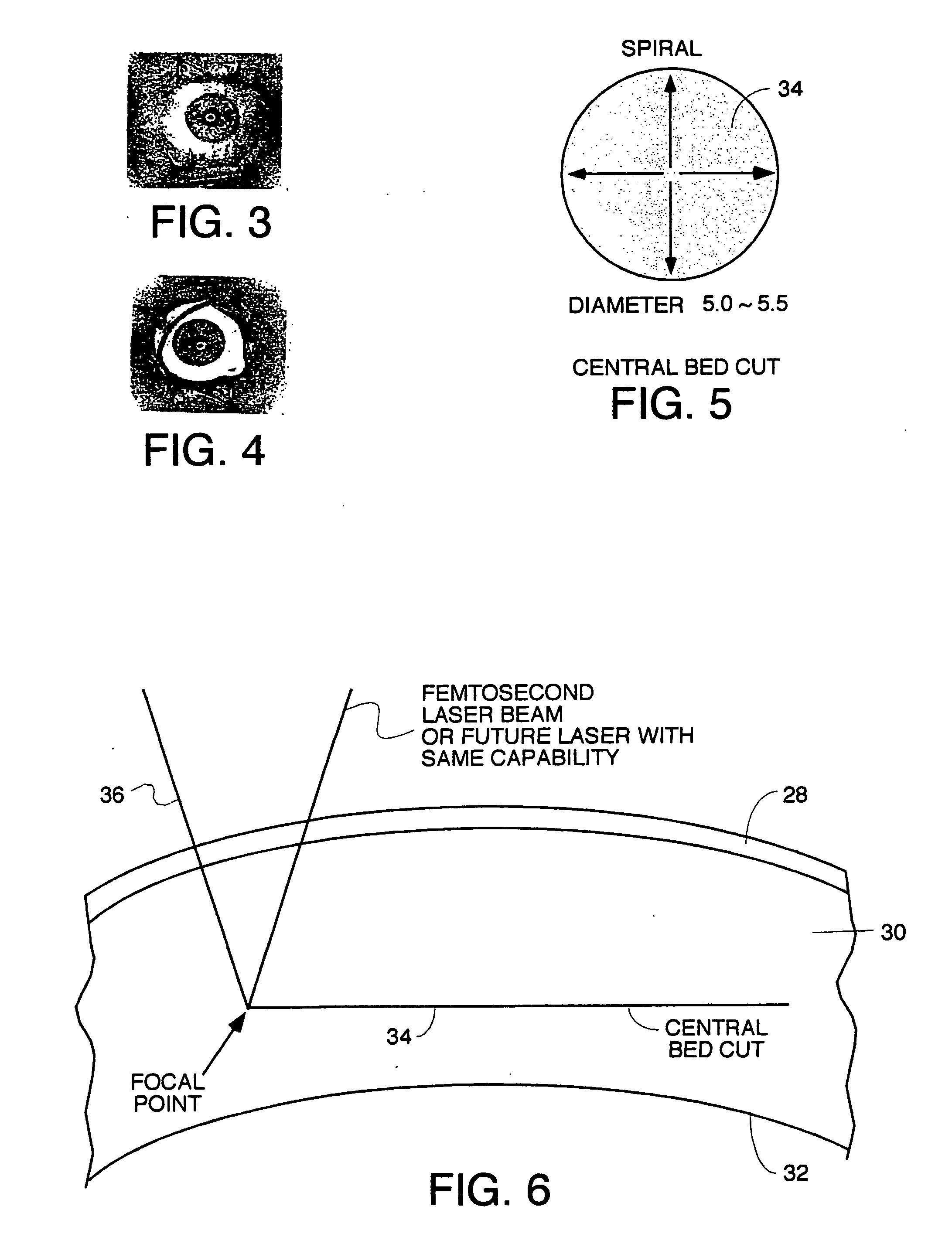 Surgical procedure and instrumentation for intrastromal implants of lens or strengthening materials