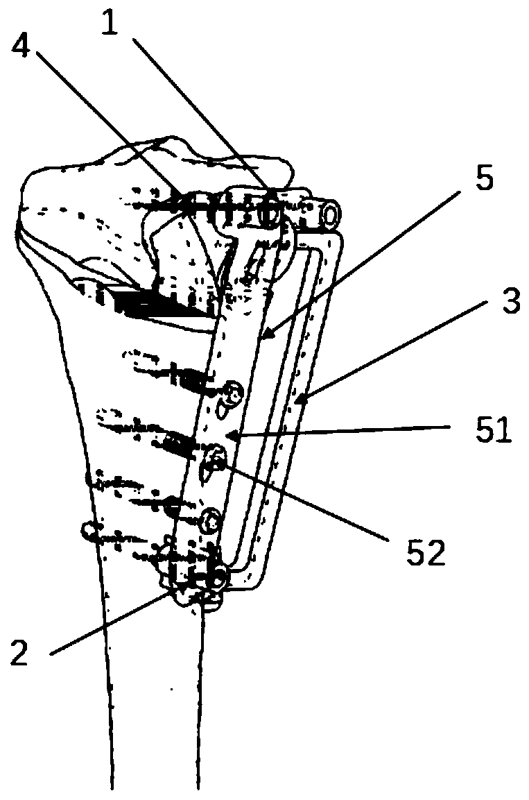 Device for high tibial osteotomy