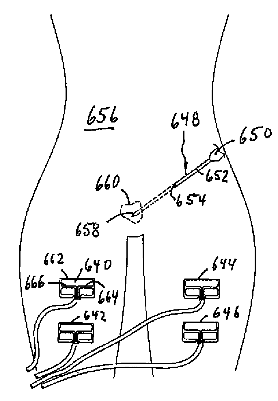 Impedance responsive ablation RF driving for moderating return electrode temperature