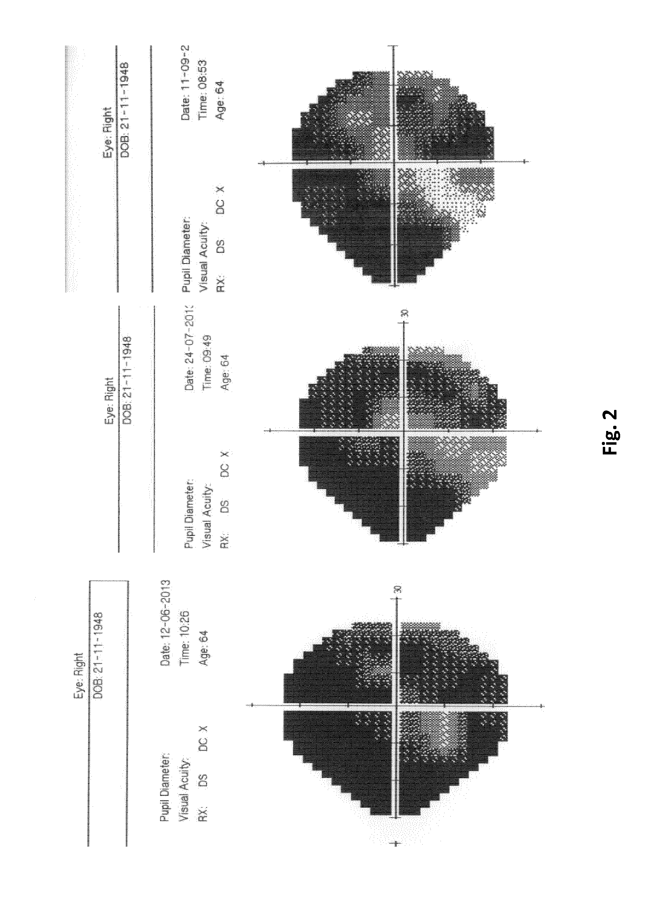 Compositions of omega 3 fatty acids to treat diseases which involve damage to the nervous system
