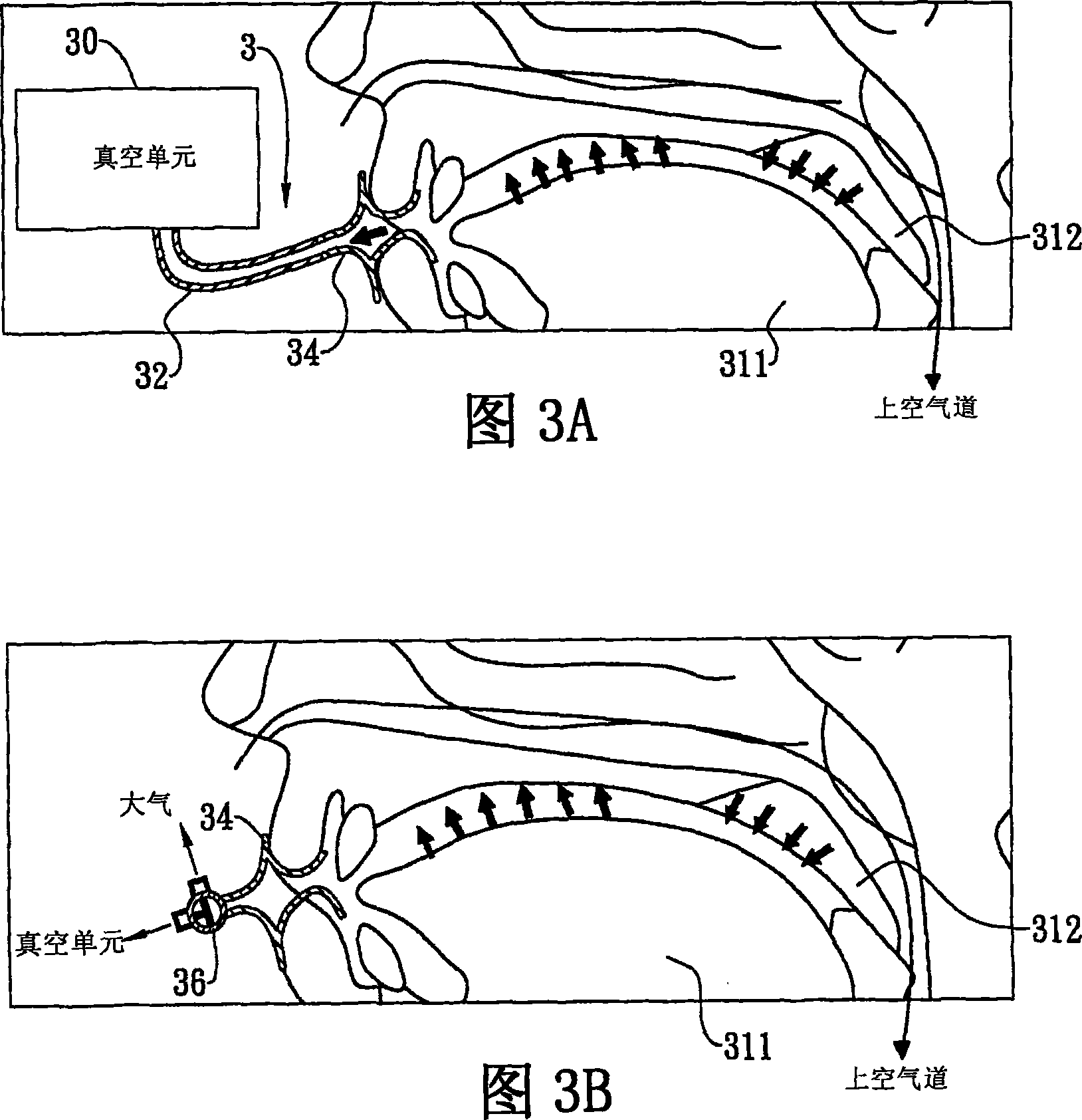 Method and device for treating patients with obstructive sleep apnea by applying negative pressure in oral cavity to patient