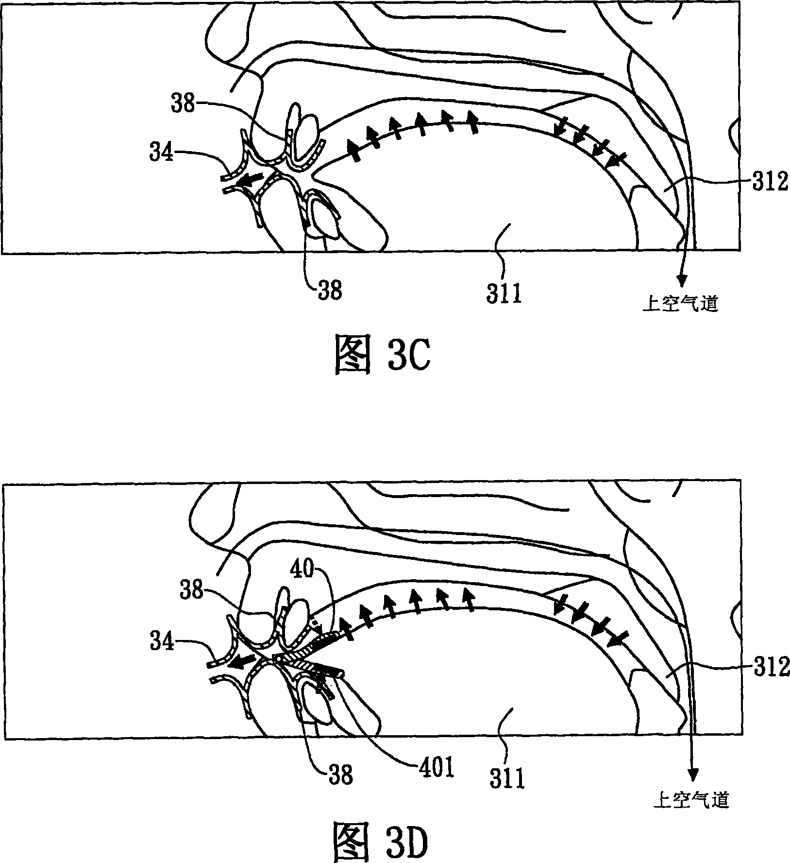Method and device for treating patients with obstructive sleep apnea by applying negative pressure in oral cavity to patient