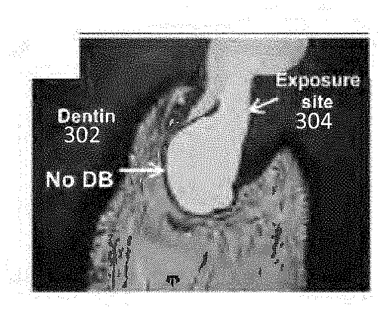 Dental composition and method of direct pulp capping