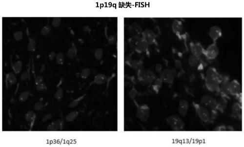 Neuroglioma 1p/19q co-deletion detection system based on next generation sequencing