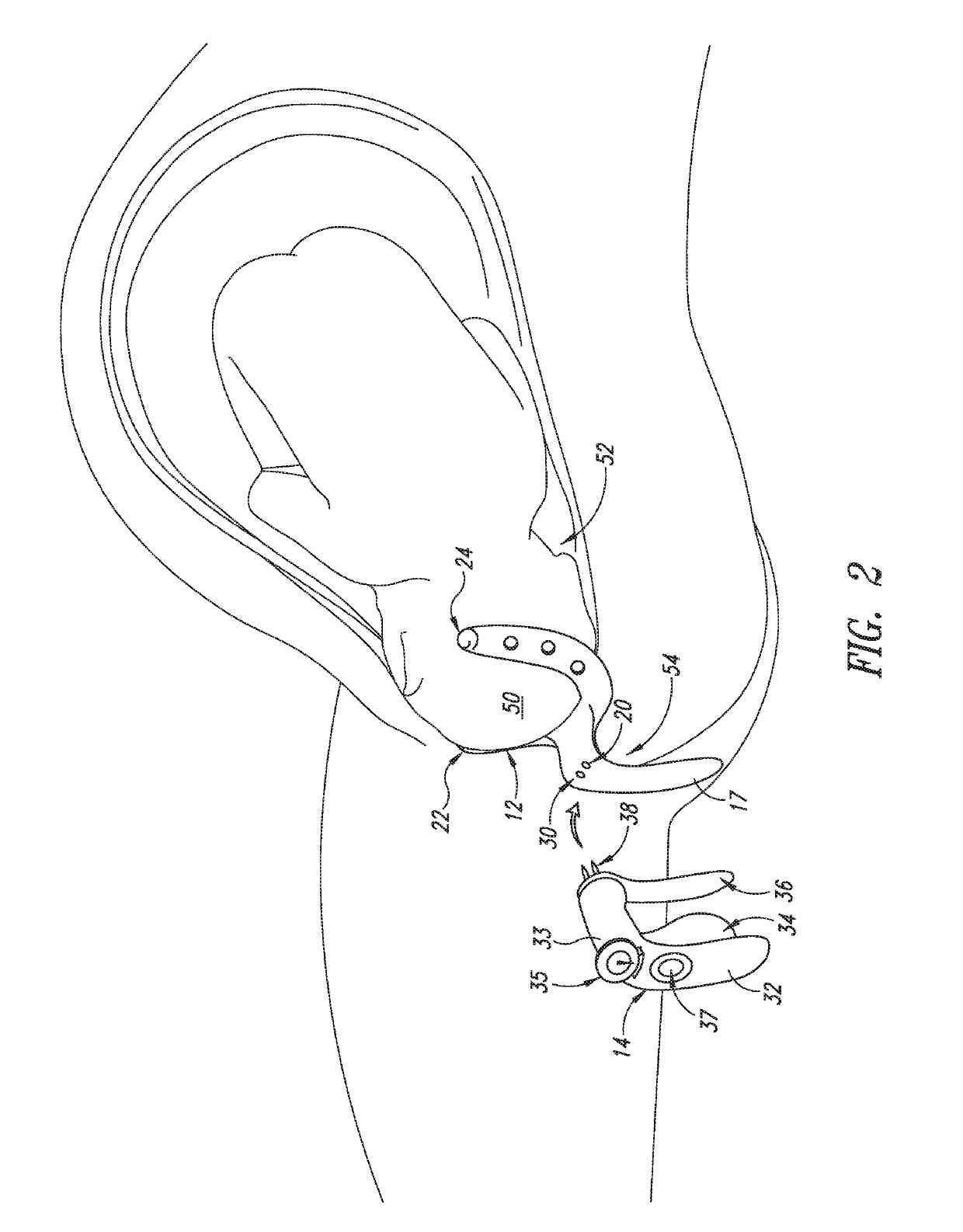 Apparatus to protect the pelvic floor during vaginal childbirth
