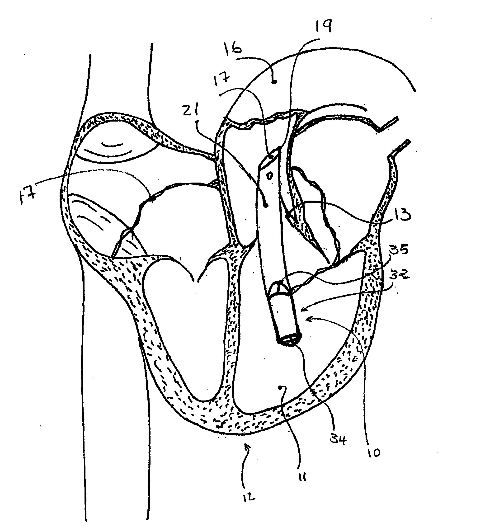 Percutaneously introduced blood pump and related methods