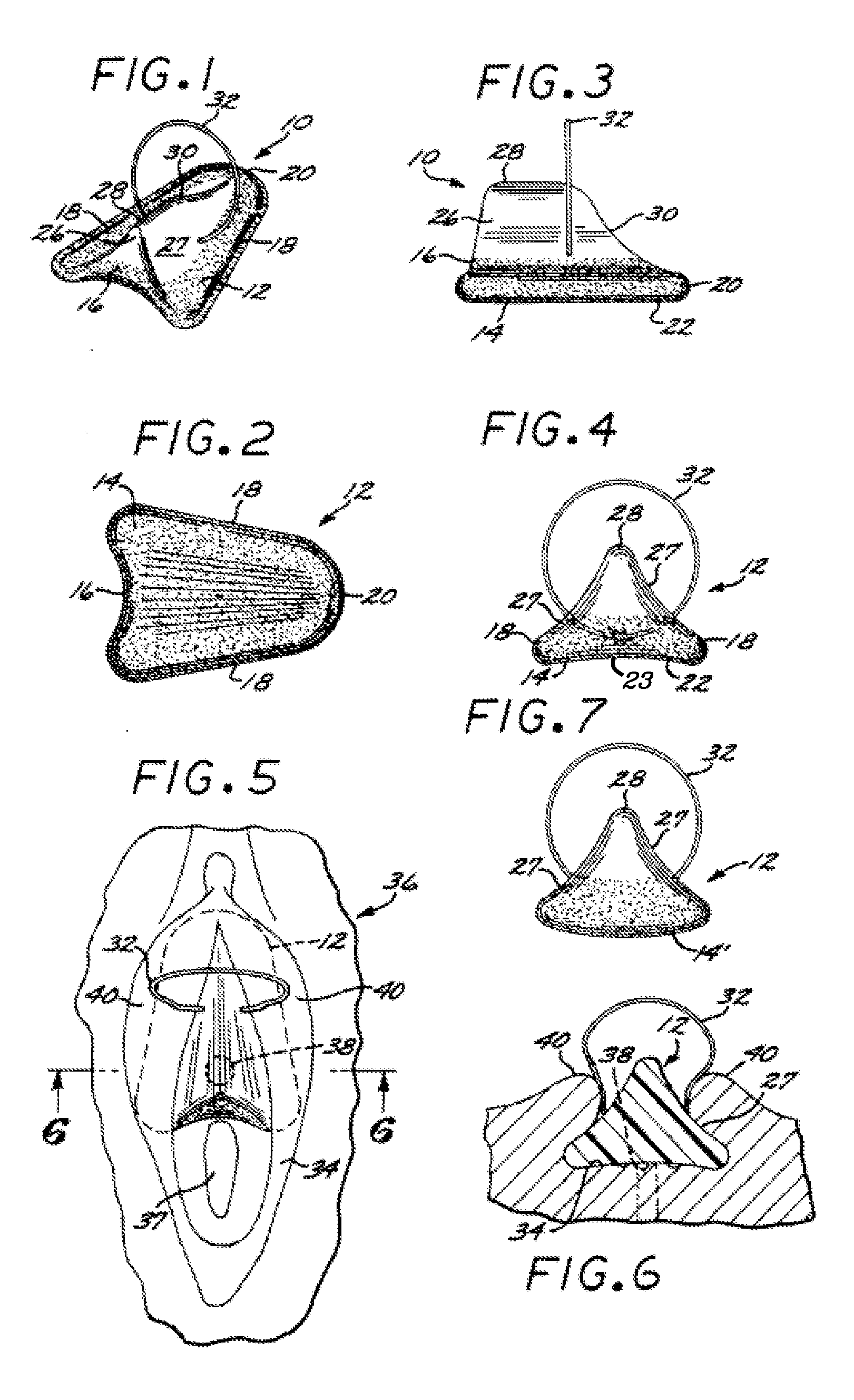 Systems and methods for incontinence control