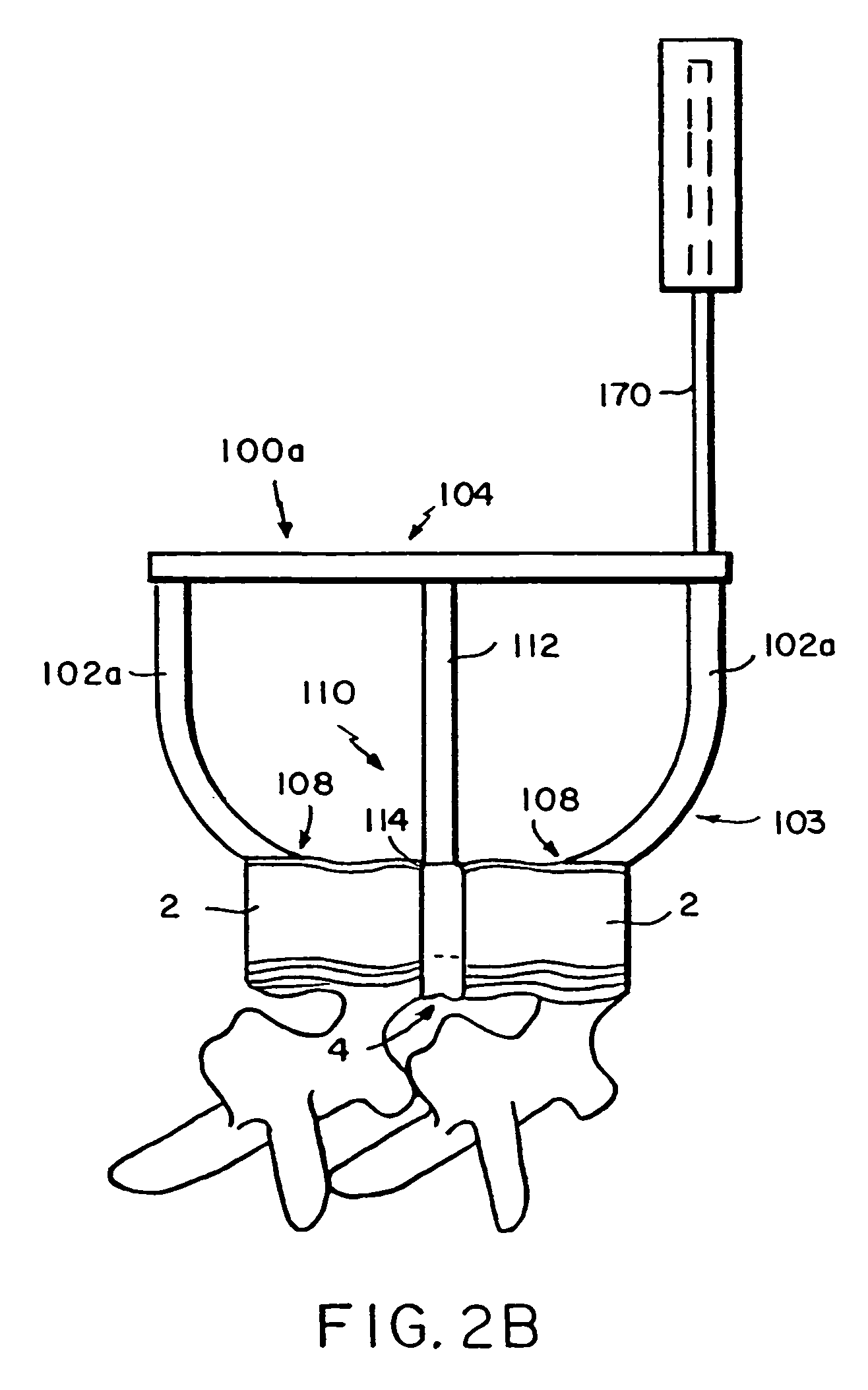 Systems and methods for spinal fixation
