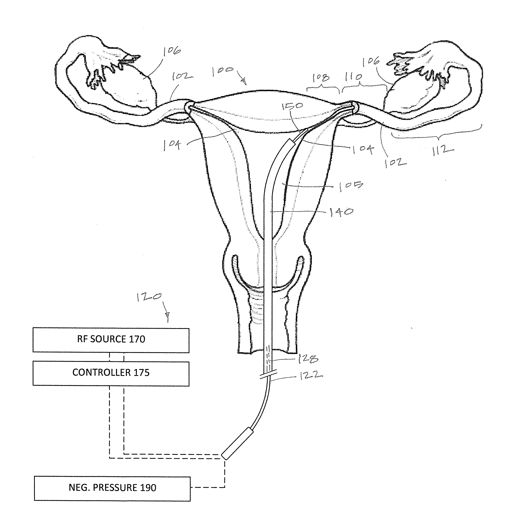 Systems and methods for permanent female contraception