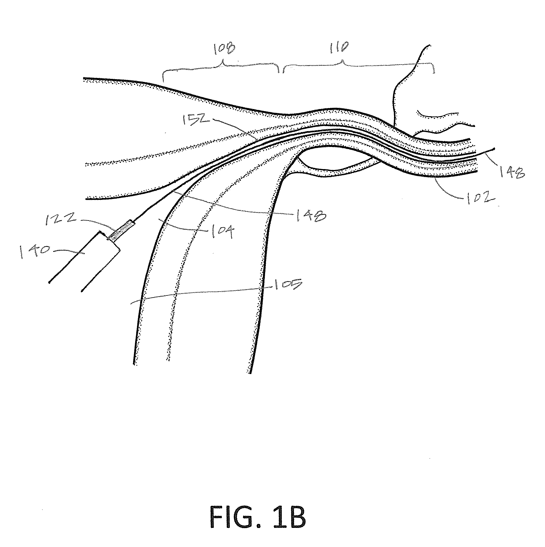 Systems and methods for permanent female contraception