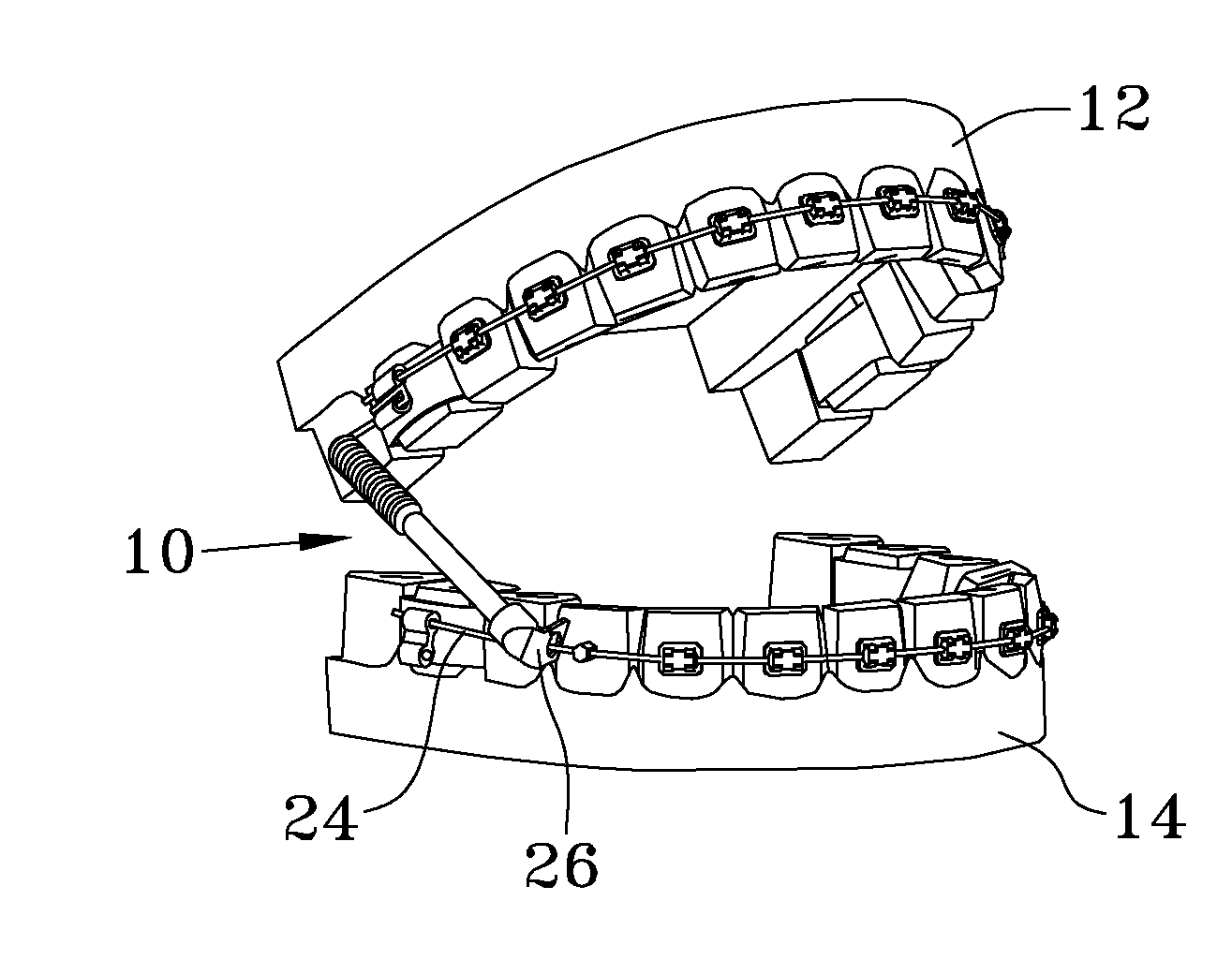 orthodontic-appliance-for-bite-correction-eureka-wisdom-buds