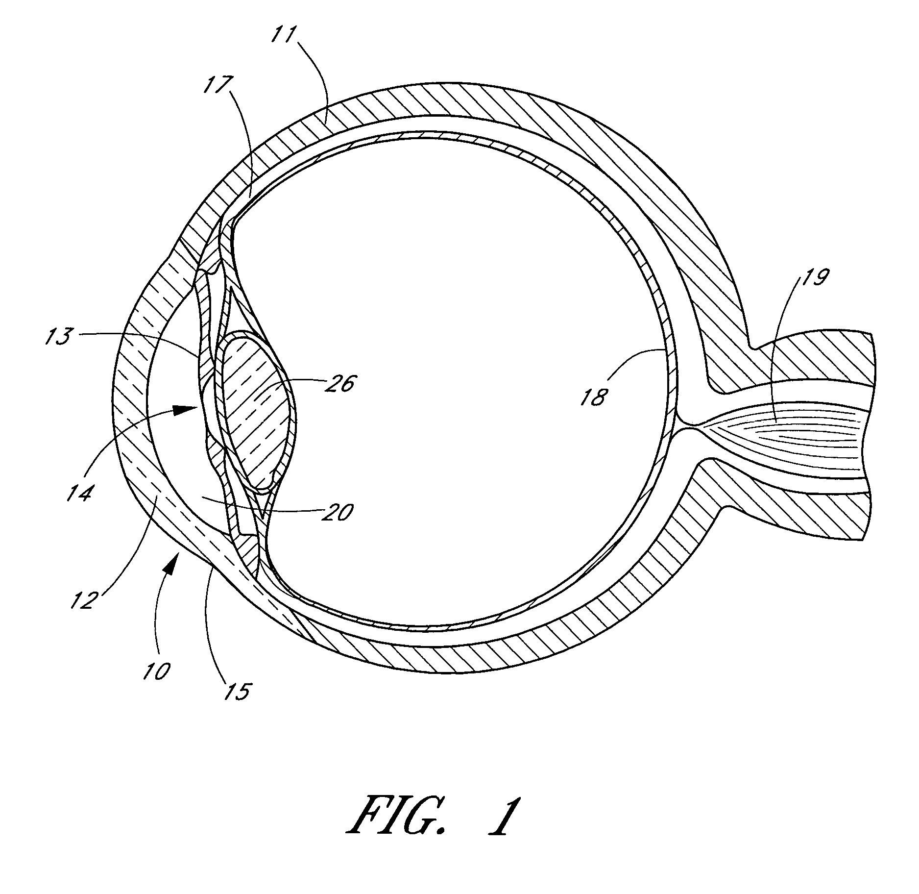 Ocular implant with anchor and multiple openings
