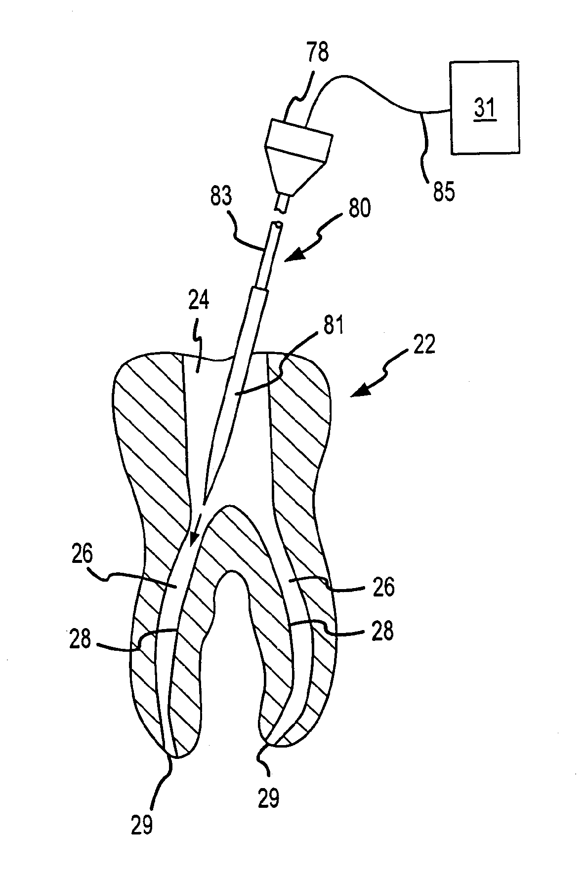Apparatus and method for root canal obturation