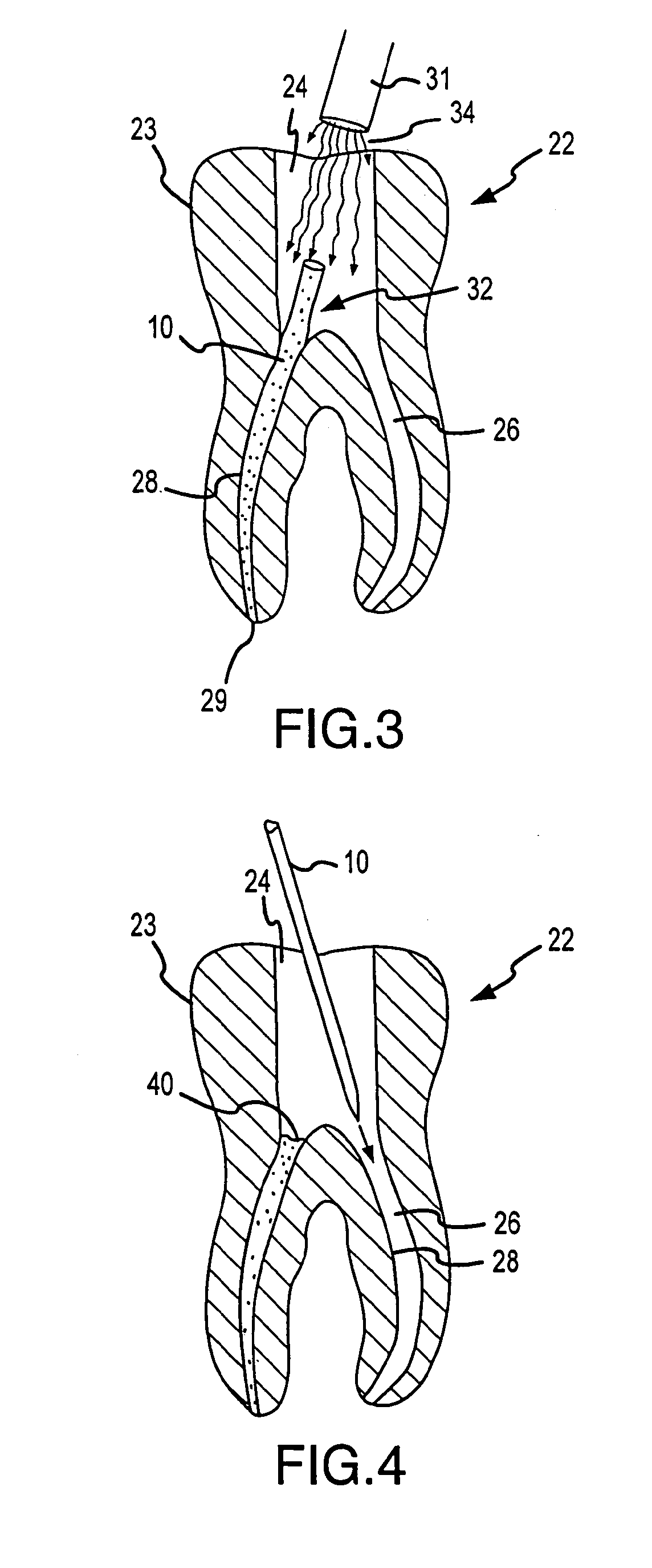 Apparatus and method for root canal obturation