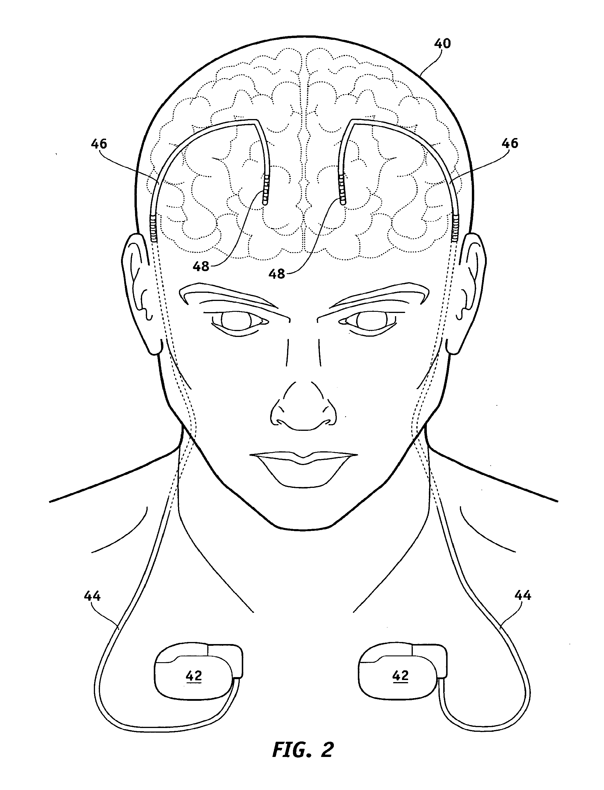 Lead Electrode for Use in an MRI-Safe Implantable Medical Device