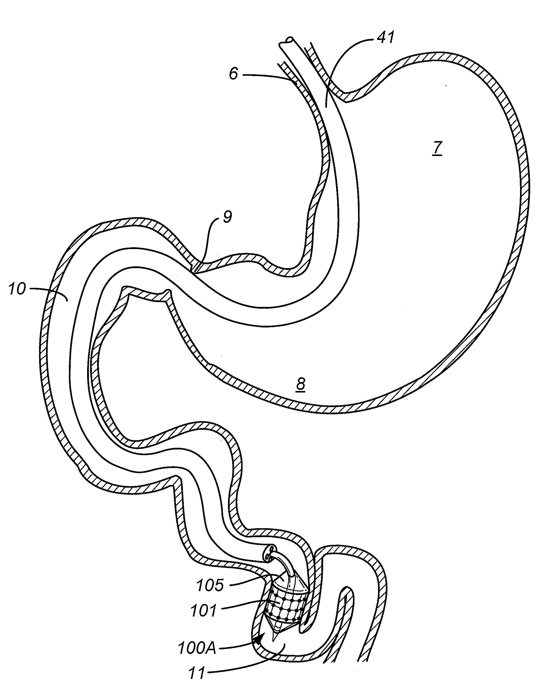 Method and apparatus for gastrointestinal tract ablation for treatment of obesity