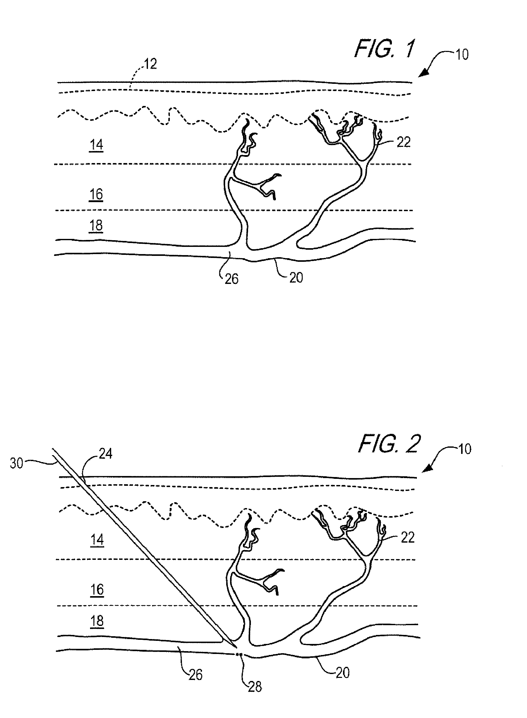 Method and kit for treatment of varicose veins and other superficial venous pathology