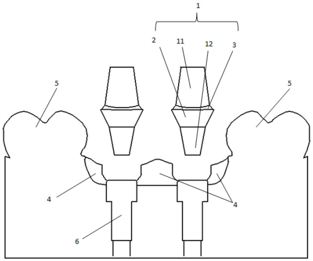 Processing method of pure titanium personalized abutment