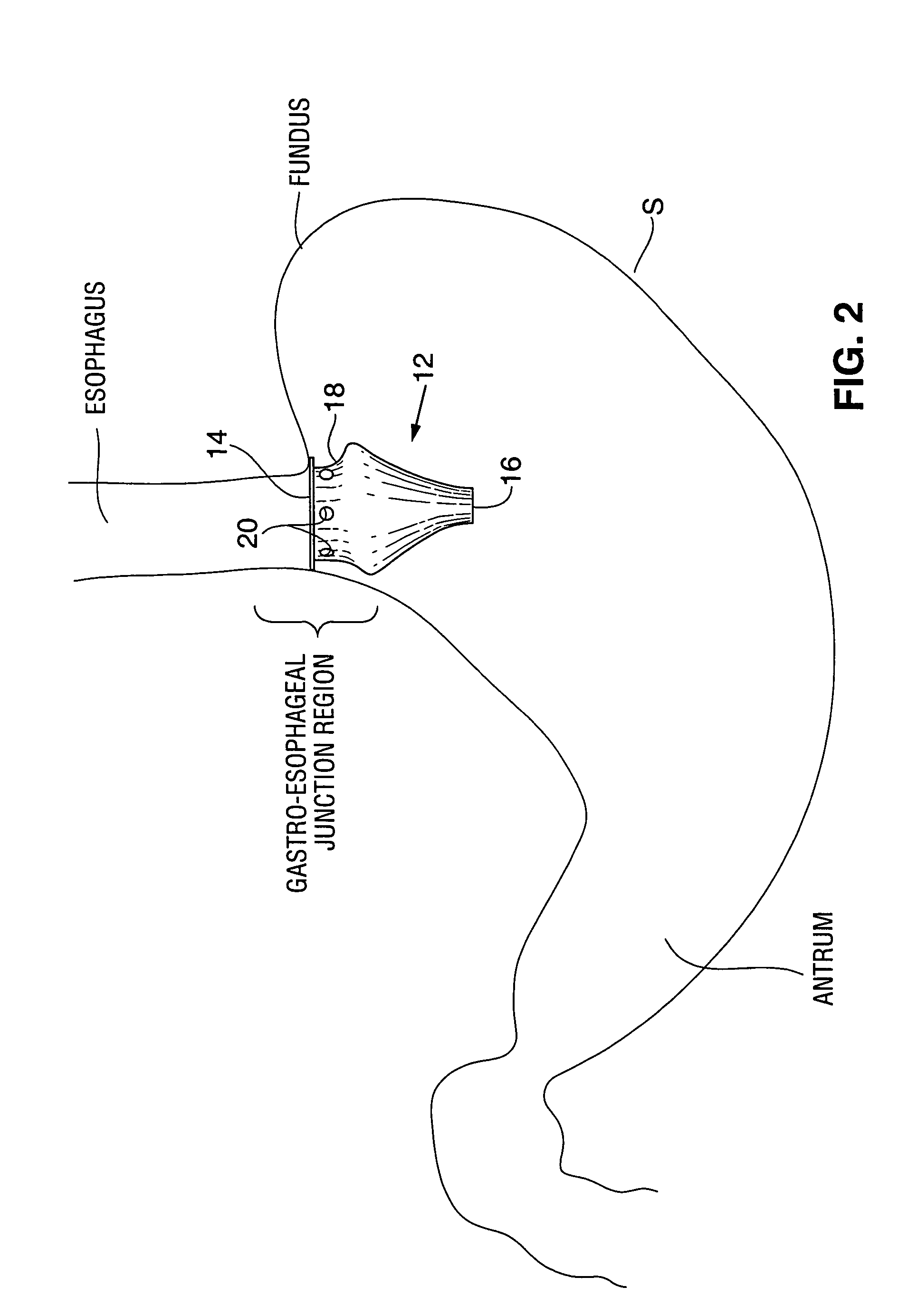 Satiation devices and methods