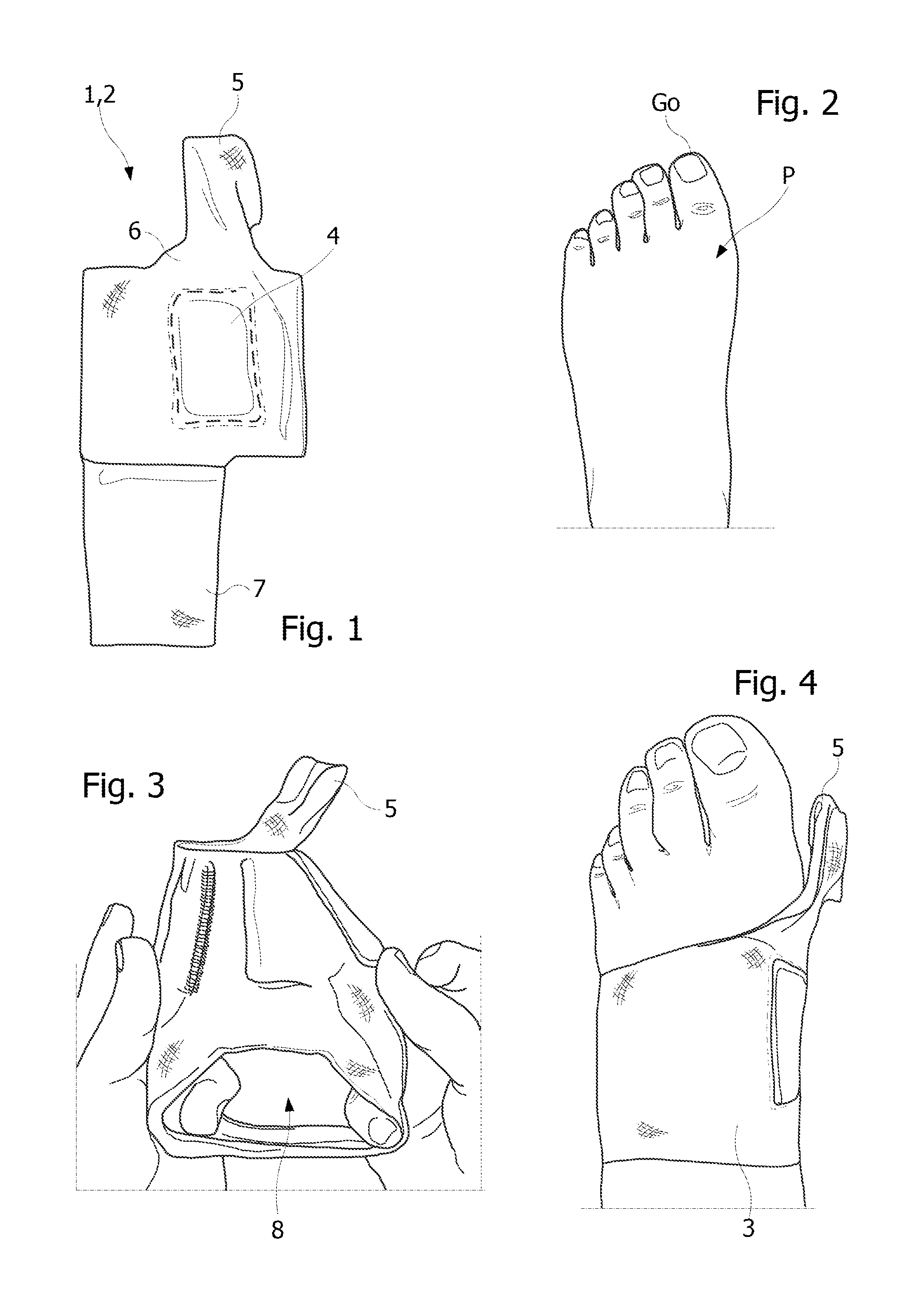 Orthopedic device for mechanical treatment of hallux valgus