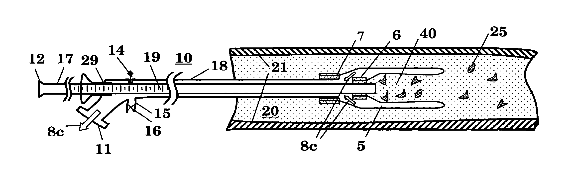 Balloon catheter