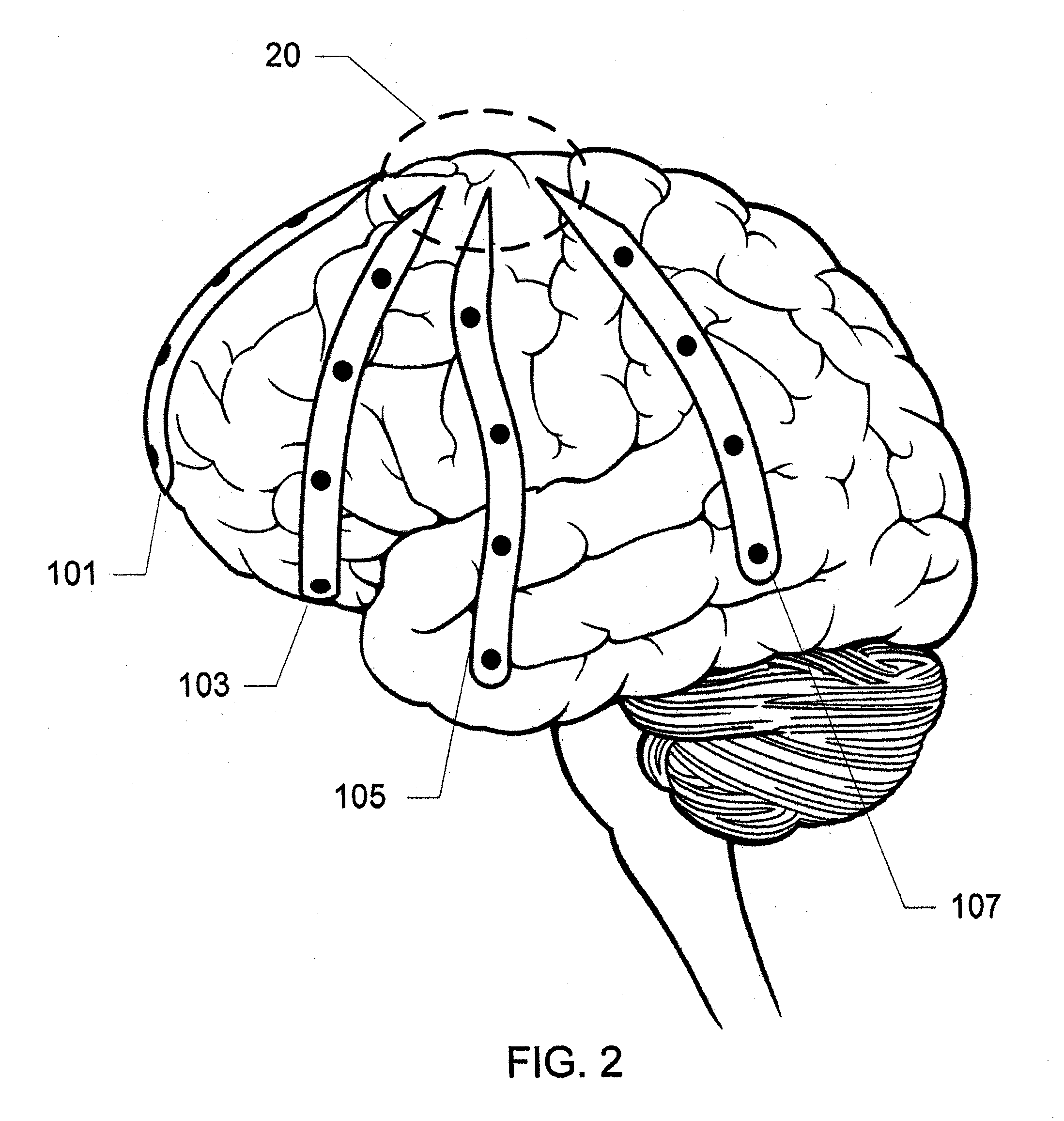 Universal Electrode Array for Monitoring Brain Activity