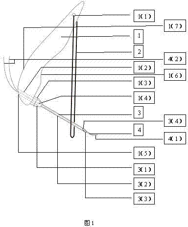 Minz deep tissue suture method and Minz deep tissue suture instrument