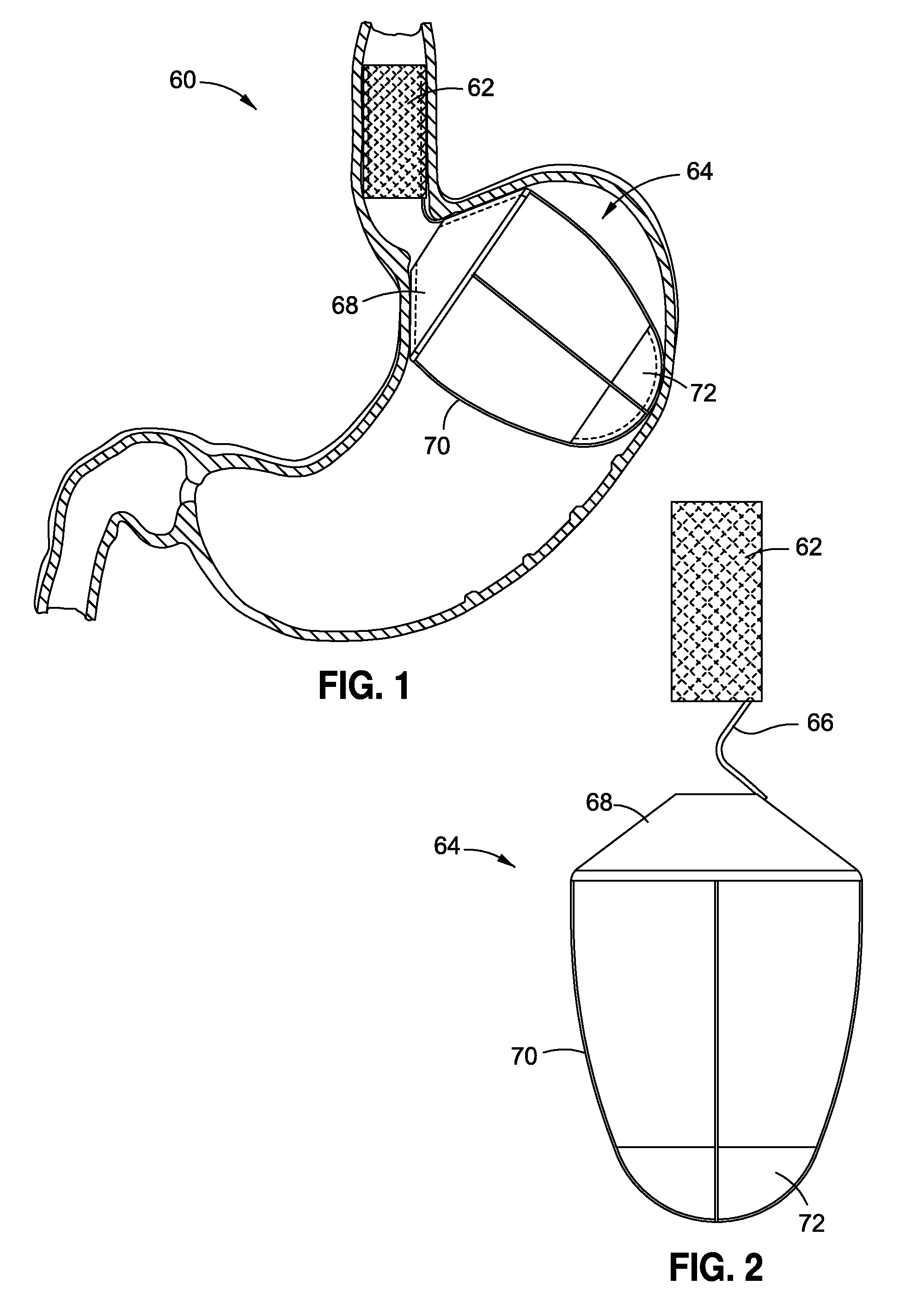 Upper stomach gastric implants