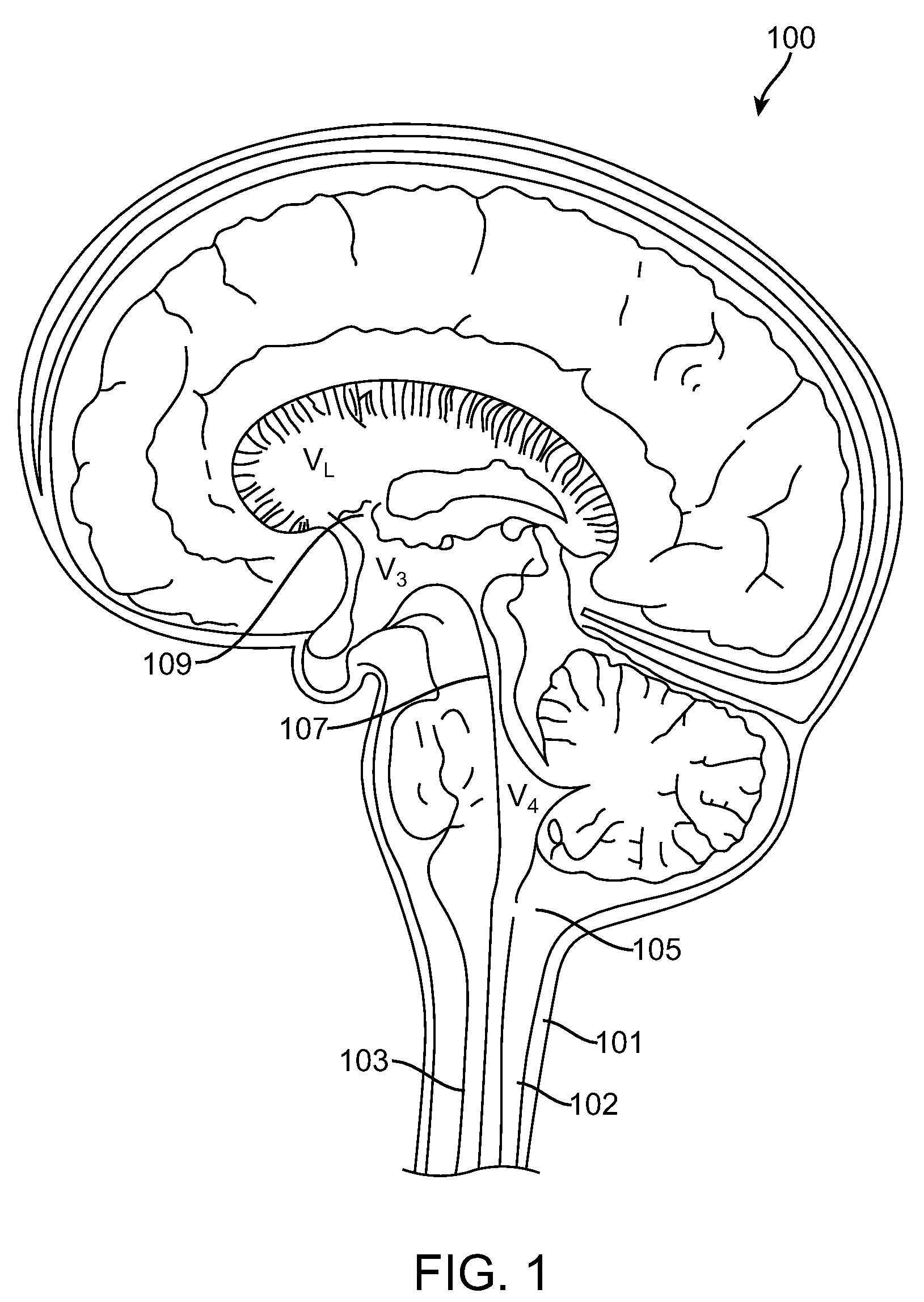 Intraventricular Shunt and Methods of Use Therefor