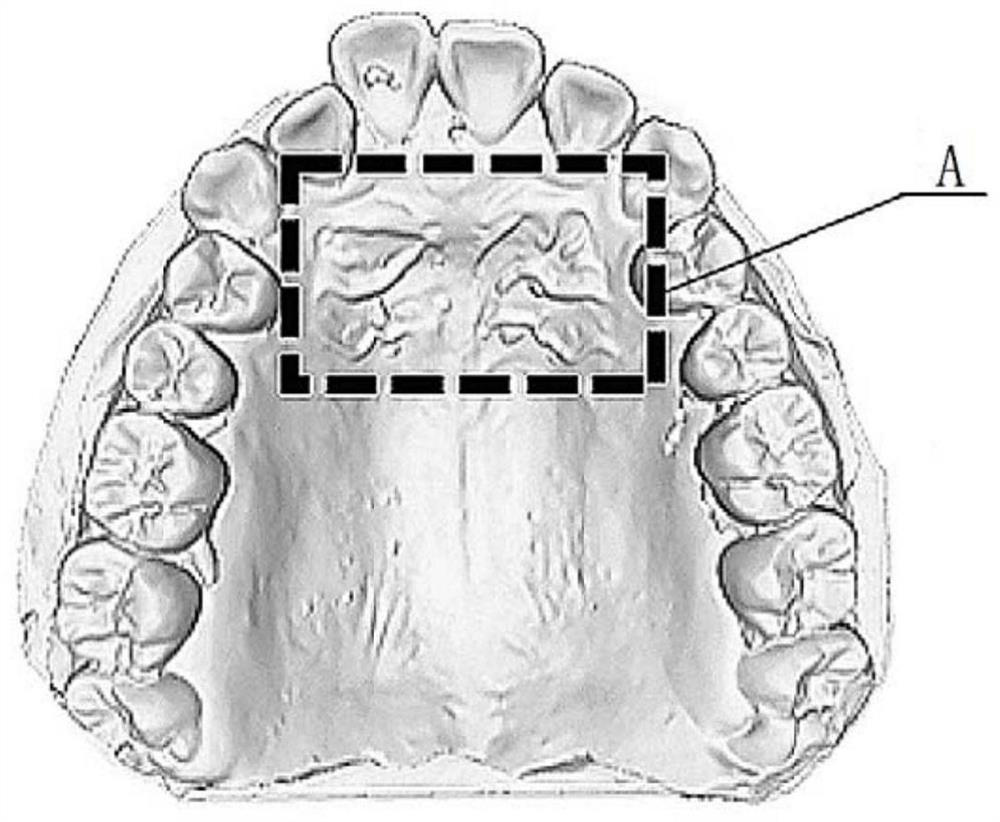Orthodontic front and back palatal plica registration method and equipment