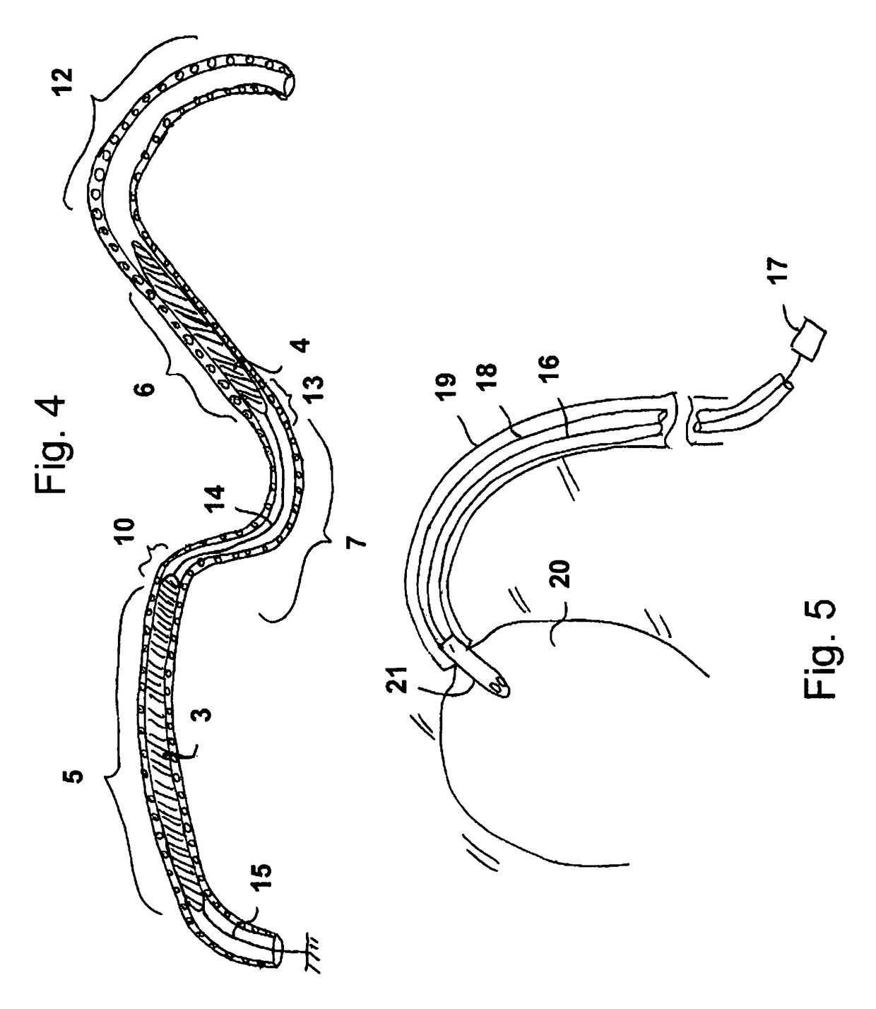 Catheter pump arrangement and flexible shaft arrangement having a core