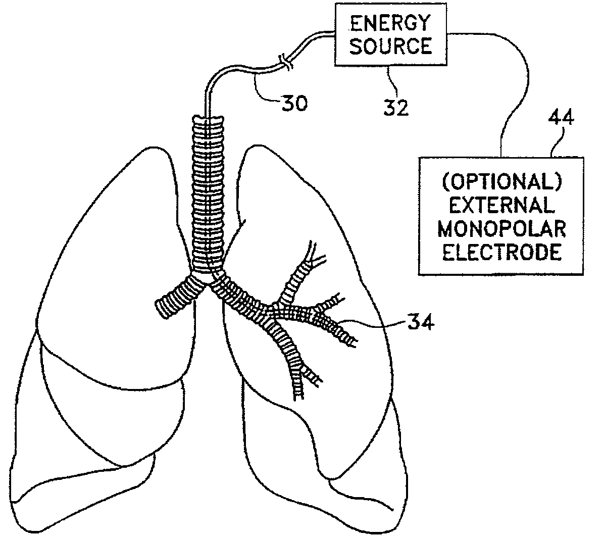 Bipolar devices for modification of airways by transfer of energy