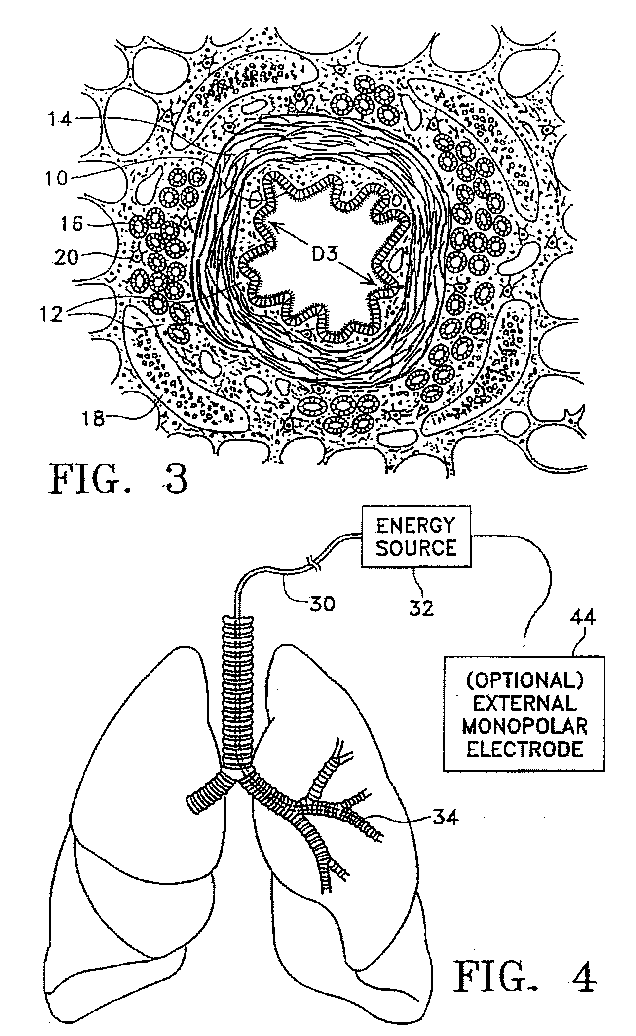 Bipolar devices for modification of airways by transfer of energy