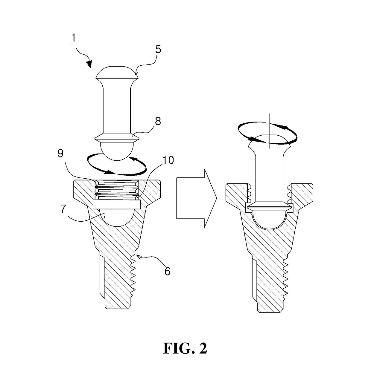 Denture fixing attachment