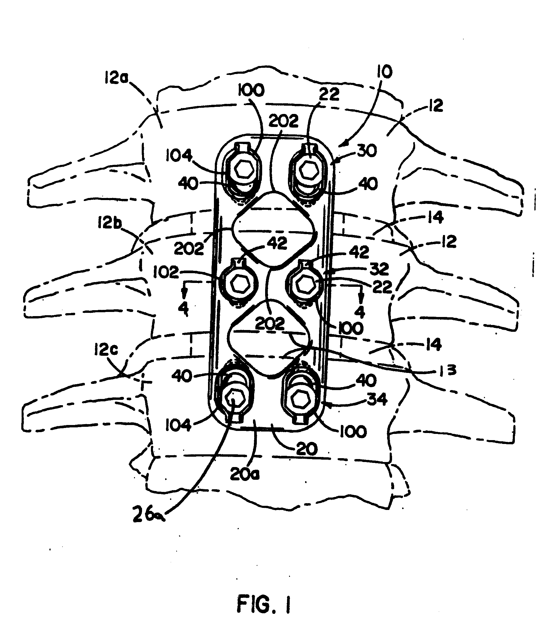 Bone plate system and methods