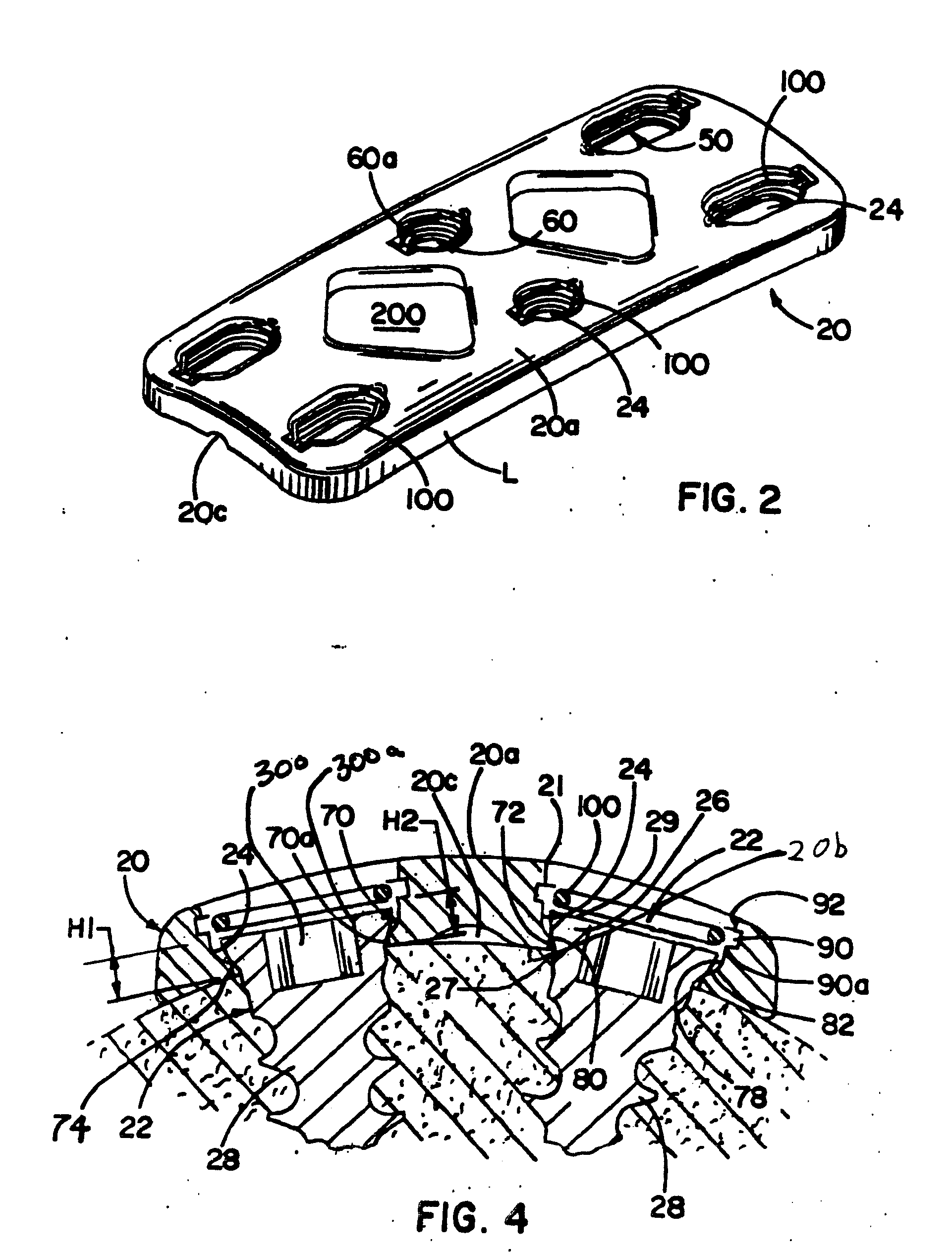 Bone plate system and methods